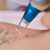 tattoo-removal-
